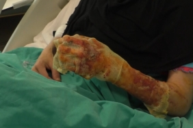 Mangal ateşine dezenfektan döken çift dehşeti yaşadı: "Eşim ateşi harlamak istedi, lütfen acele etmeyin"