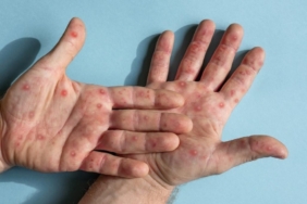 Maymun çiçeğinin yayılmasını engellemenin en etkili yolları