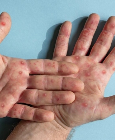 Maymun çiçeğinin yayılmasını engellemenin en etkili yolları