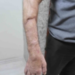 Uzuvları kopan iki hasta, ameliyatla hayata yeniden tutundu