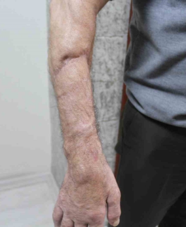 Uzuvları kopan iki hasta, ameliyatla hayata yeniden tutundu