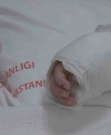Üzerine kaynar su dökülen bebeğin vücudunun yüzde 27’si yandı