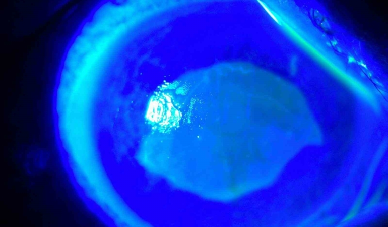 ’Kırlangıç otu kullanımı’na dikkat, uzmanlar uyarıyor: “Gözlerine suyunu damlattı, göremez hale geldi”