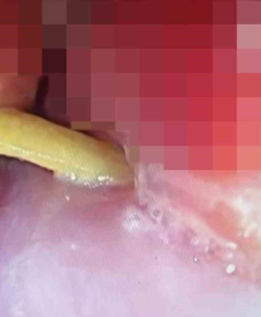 Boğazına saplanan 5 santimlik kemik öldürüyordu