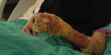 Mangal ateşine dezenfektan döken çift dehşeti yaşadı: "Eşim ateşi harlamak istedi, lütfen acele etmeyin"