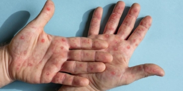 Maymun çiçeğinin yayılmasını engellemenin en etkili yolları