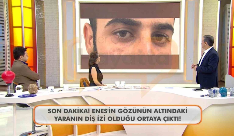Canlı yayında Enes Güran’ın gözünün altındaki diş izine dikkat çekildi