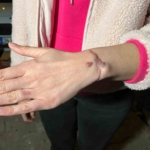 Esenyurt’ta güzellik merkezinde dövme sildirme işlemi yaptıran kadın: “Kolumu yaktılar”