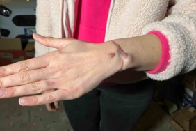 Esenyurt’ta güzellik merkezinde dövme sildirme işlemi yaptıran kadın: “Kolumu yaktılar”