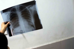 Bel ağrılarınız iltihaplı romatizma olabilir