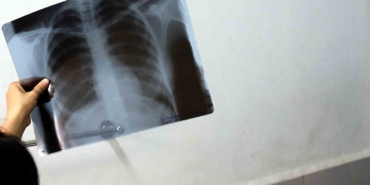 Bel ağrılarınız iltihaplı romatizma olabilir