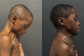 7 yaşındaki çocuğun boynu yandı, çenesi gövdesine yapıştı