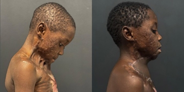 7 yaşındaki çocuğun boynu yandı, çenesi gövdesine yapıştı