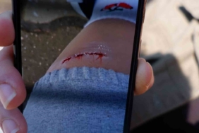 Edirne’de köpeğin ısırdığı kadın yaralandı