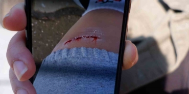 Edirne’de köpeğin ısırdığı kadın yaralandı