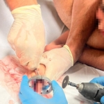 Bursa’da çocuğun parmağı çeşme aynasına sıkıştı