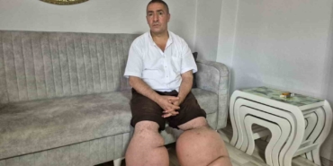 15 yıldır fil hastalığıyla mücadele ediyor