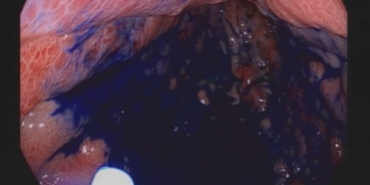 Boyama yöntemi ile mide ve bağırsak kanserinde erken teşhis