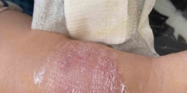 Büyükçekmece’de sigara dumanı tartışmasında kolunu ısırdı