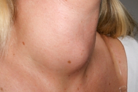 Boynunuzda şişlik varsa dikkat