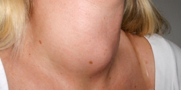 Boynunuzda şişlik varsa dikkat