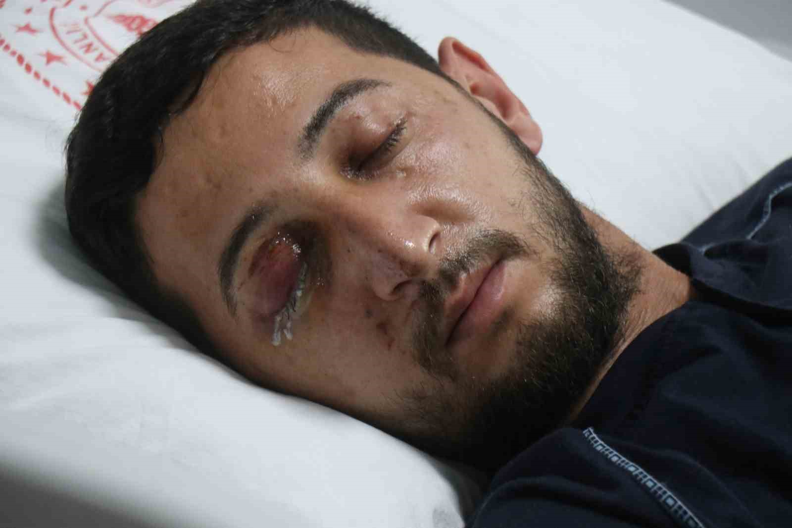 Düğün eğlencesi kabusa döndü: Sağ gözünden oldu