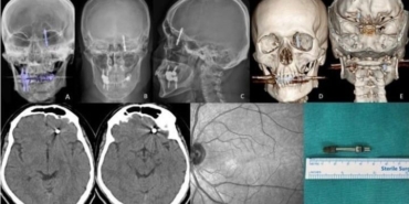 Beynine saplanan implant hayatını kararttı: 2 yıldır adalet bekliyor