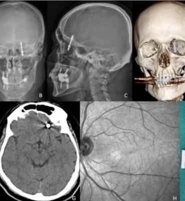 Beynine saplanan implant hayatını kararttı: 2 yıldır adalet bekliyor