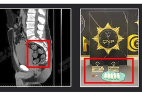 Tomografide şok eden görüntü...Uyuşturucu midesinden çıkarıldı
