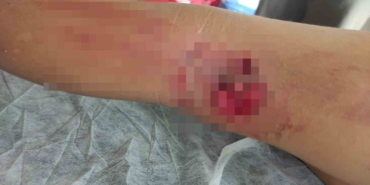 Okula giderken sokak köpeğinin saldırısına uğradı