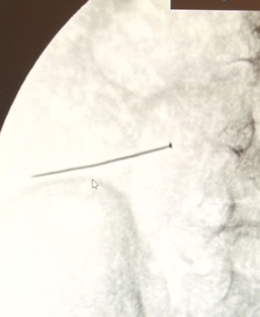 Ağrıyla kıvranan 2 yaşındaki çocuğun bağırsağından 3 santimlik iğne çıktı