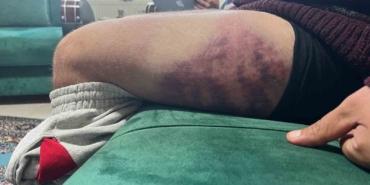 Vicdanları yaralayan olay: Otizmli şahıs odunluğa baktı diye odunla darbedildi