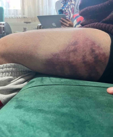 Vicdanları yaralayan olay: Otizmli şahıs odunluğa baktı diye odunla darbedildi