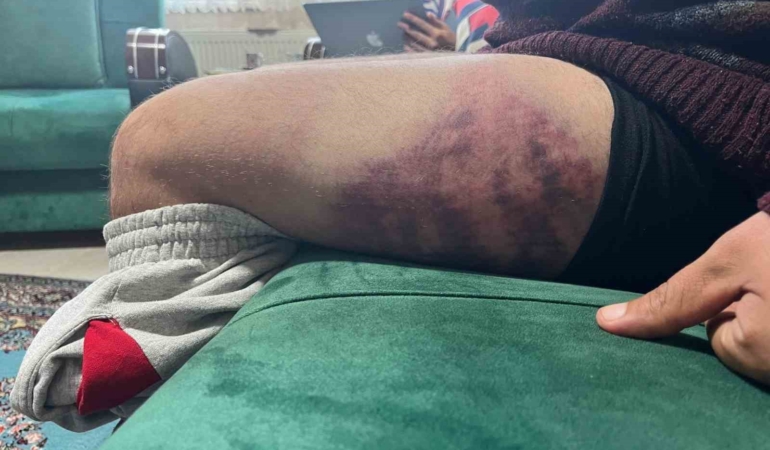 Vicdanları yaralayan olay: Otizmli şahıs odunluğa baktı diye odunla darbedildi