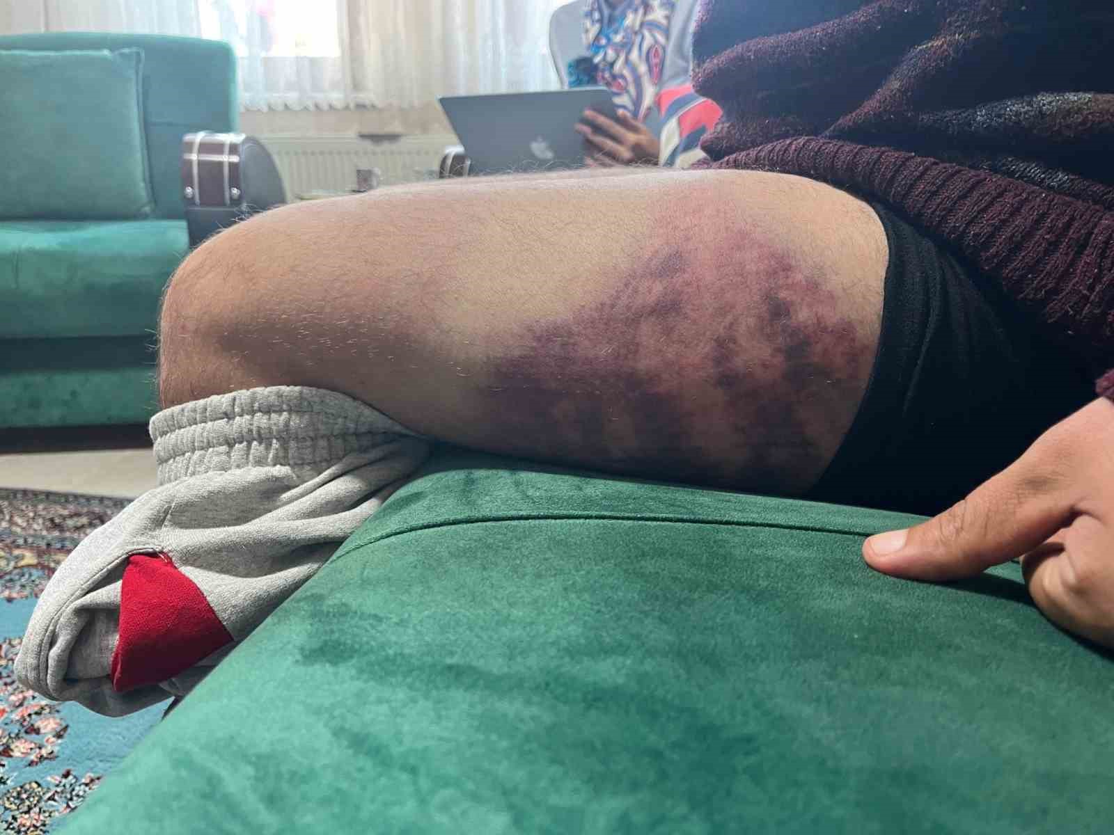 Vicdanları yaralayan olay: Otizmli şahıs odunluğa baktı diye odunla darbedildi