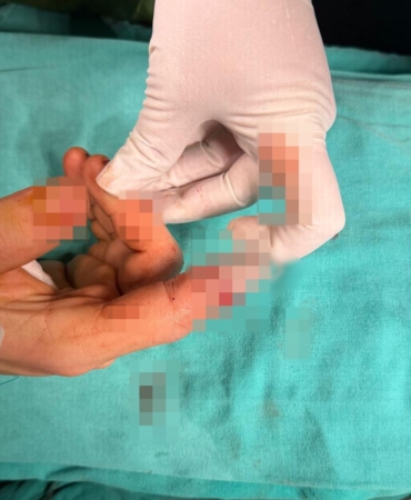 Bandırma’da asansör kazasında kopan parmak başarılı ameliyatla kurtarıldı