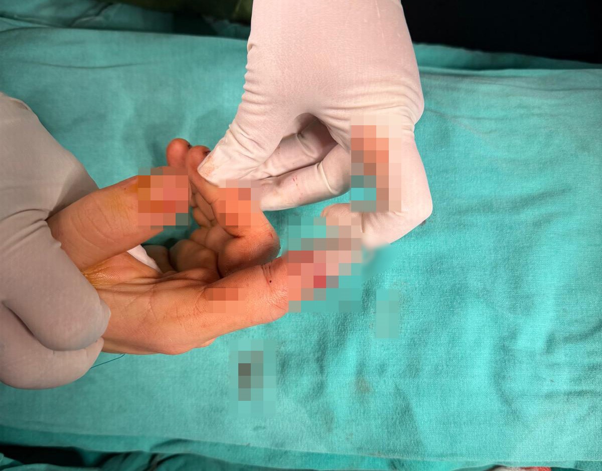 Bandırma’da asansör kazasında kopan parmak başarılı ameliyatla kurtarıldı