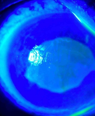 ’Kırlangıç otu kullanımı’na dikkat, uzmanlar uyarıyor: "Gözlerine suyunu damlattı, göremez hale geldi"