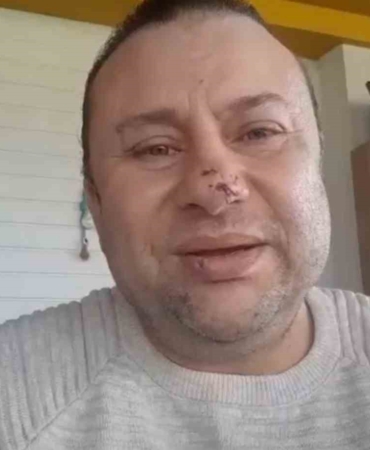 Pitbull saldırısına uğrayan Onur Akay o anları anlattı: "Ben ölümden döndüm"