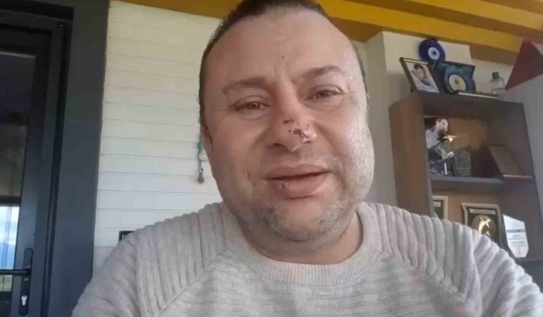Pitbull saldırısına uğrayan Onur Akay o anları anlattı: "Ben ölümden döndüm"